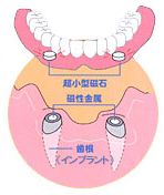 磁石式入れ歯とは