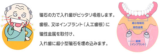 磁石式入れ歯とは