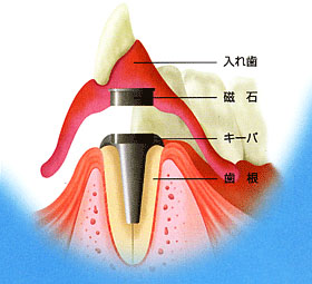 磁石式入れ歯の構造効果