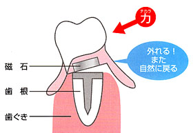 磁石式入れ歯の固定方法
