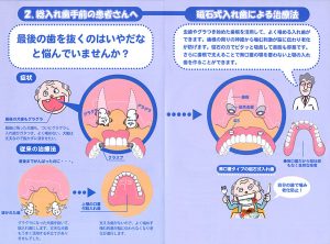 denture_img005