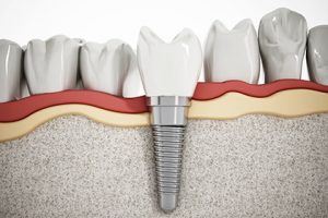Illustration of teeth showing dental implant structure