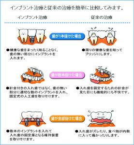 implant_img002