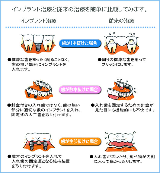インプラント治療と従来の治療