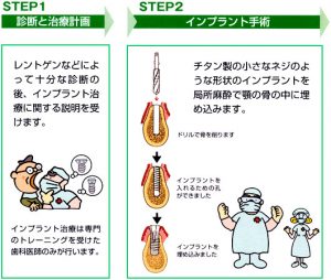 implant_img003