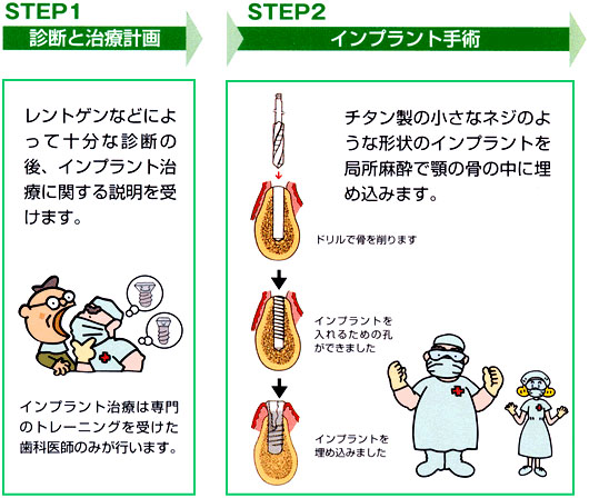 インプラント治療の流れ